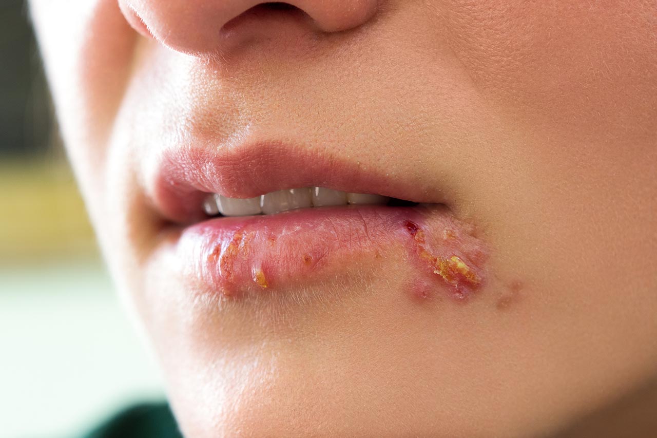 skin picking scabs at mouth